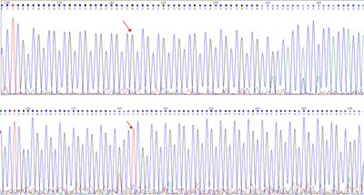 Case report: Identification of a frameshift mutation in GC enrichment and the GCC repeat region of the androgen insensitivity receptor (AR) gene in a patient with complete androgen insensitivity syndrome by whole-exome sequencing (WES) combined with specific PCR and deep sequencing